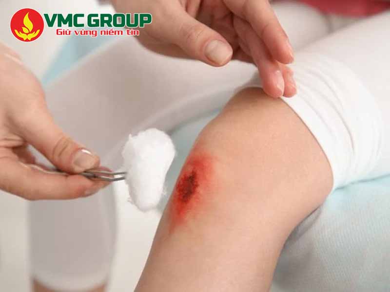 Cồn tuyệt đối dùng để lau các vết thương hở để sát trùng