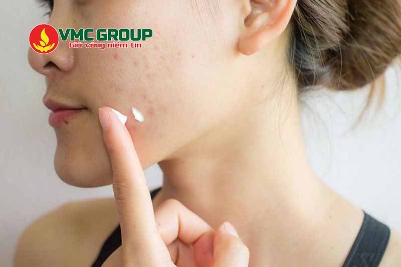 Carbomer được dùng trong gel trị mụn