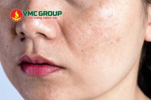 L-Cystine giúp hỗ trợ điều trị nám