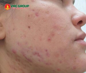 Niacinamide giúp giảm thâm mụn trên da