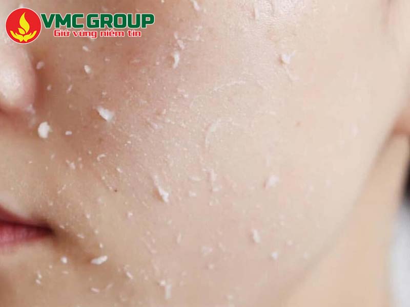 Acid lactic trong mỹ phẩm- Chất tẩy tế bào chết